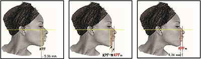 modification of Schwarz's jaw profile field