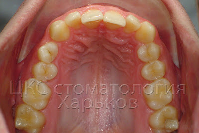 Неровные зубы до ортодонтического лечения