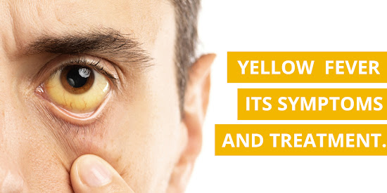 Yellow Fever: Its Symptoms and Treatment