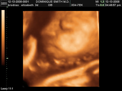 3d ultrasound pictures. 3d ultrasound pictures at 26
