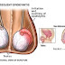 Cara Memesan Obat Untuk Testis Bengkak