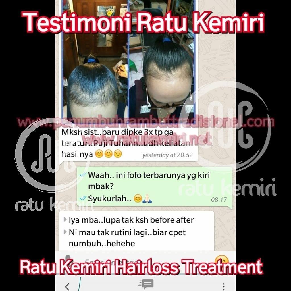 Agen Minyak Kemiri Murni Ratu Kemiri Jual Obat Penumbuh Rambut