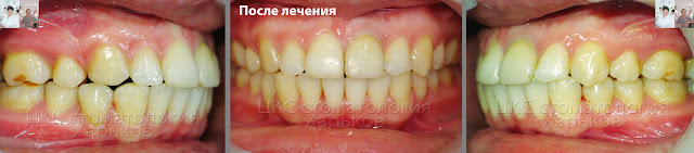 Зубы после лечения брекетами случая смещенной средней линии