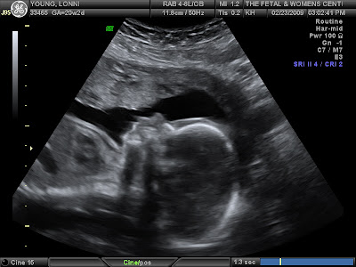 Baby Ultrasound Pictures on The Young S Journey  3d Ultrasound Pictures Of Our Girl