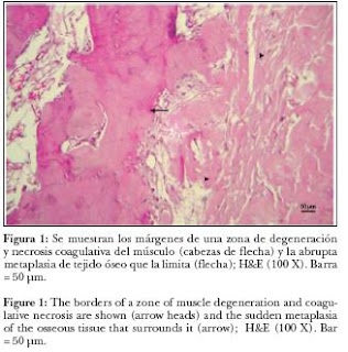 miositis osificante 