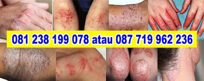 Obat Tradisional Tuntaskan Eksim Kering