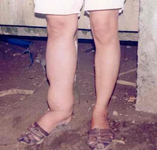 Penyakit-kaki-gajah