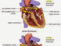 The Big Risk Factors and Causes of Atrial Fibrillation
