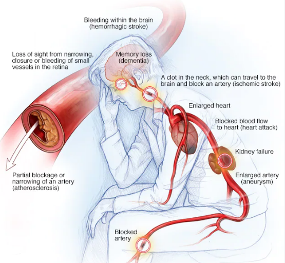 What Is Hypertension (High Blood Presure)