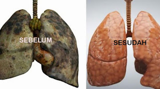 Bahaya Peroko Pasif dan Cara Mudah Membersihkan Paru-paru dari Asap