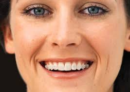 Hiện tượng cười hở lợi, có thể niềng răng chữa trị được không?