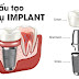 Cấy ghép răng implant là phương pháp gì?