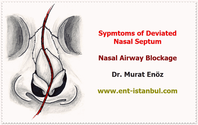 Deviated Nasal Septum - Symptoms of Nasal Septum Deviation - Computer Tomography Imaging Before The Septoplasty Operation - Technique of Septoplasty Operation - Caudal Septoplasty and  External Strut Graft Technique - Septoplasty Operation in Istanbul - Septoplasty Operation in Turkey - Septum Deviation Correction Surgery in Istanbul