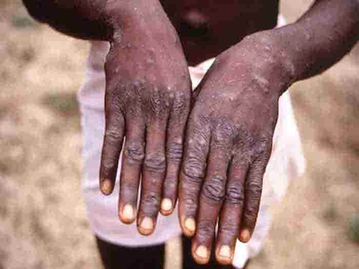 Monkeypox has likely spread under the radar 'for some time', says WHO, National, News, Top-Headlines, Newdelhi, Virus, Journalist, Britain, Report, Africa, UN, WHO, Man, Case.