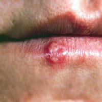 Cold Sores In Mouth Cure : Foods To Avoid With Oral Herpes Cold Sores