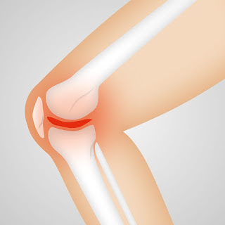 Symptoms and Remedies for Osteoarthritis