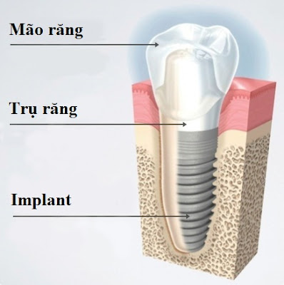 Trụ Implant có mấy loại ?