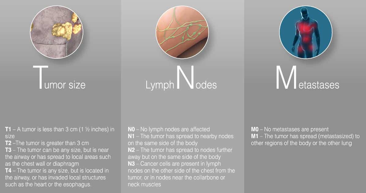 Stage 3 Lung Cancer Life Expectancy - CancerOz