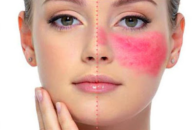 Some Of The Best Rosacea Skin Care Tips Treatment