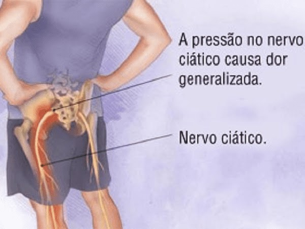 Ventosas no tratamento da dor no nervo ciático. As ventosas são uma técnica antiga e tradicional de tratamento que têm sido usadas na medicina chinesa há milhares de anos. Essa técnica consiste em colocar ventosas na pele do paciente para criar uma pressão negativa que puxa os tecidos para dentro das ventosas. Isso pode melhorar a circulação sanguínea e linfática, aliviar a tensão muscular e reduzir a inflamação, o que pode ser benéfico no tratamento da dor no nervo ciático.  O nervo ciático é o nervo mais longo do corpo humano, que se estende da parte inferior das costas até as pernas e os pés. Quando esse nervo é comprimido ou inflamado, pode causar uma dor intensa e incapacitante que pode afetar a qualidade de vida do paciente.  As ventosas podem ajudar a reduzir a pressão sobre o nervo ciático, melhorando a circulação sanguínea e linfática na área afetada. Isso pode ajudar a reduzir a dor e a inflamação, aliviar a tensão muscular e melhorar a flexibilidade e a mobilidade.  O terapeuta Vico Massagista pode personalizar a sessão de ventosas de acordo com as necessidades individuais do paciente, ajustando a intensidade do vácuo e a duração da sessão para obter os melhores resultados. É importante lembrar que o uso de ventosas deve ser feito em conjunto com outras formas de tratamento, como fisioterapia e medicamentos prescritos pelo médico, para obter resultados ótimos e duradouros no tratamento da dor no nervo ciático.