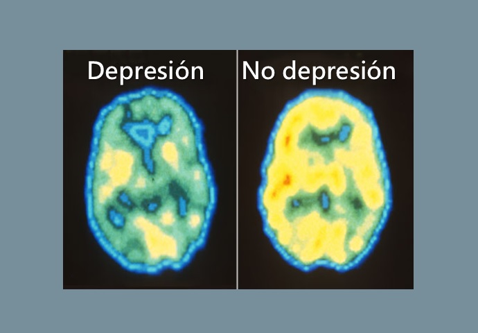 Depresión síntomas emocionales, signos físicos y más