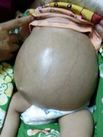 Απίστευτο: Χειρουργική επέμβαση σε 10 μηνών βρέφος για να αφαιρέσουν έμβρυο που μεγαλώνει στην κοιλιά του 