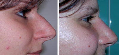 Rhinoplasty Pictures