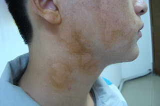 Segmental Vitiligo Face  Treatment
