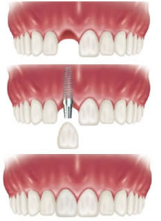 Các bước thực hiện cấy ghép răng Implant ?