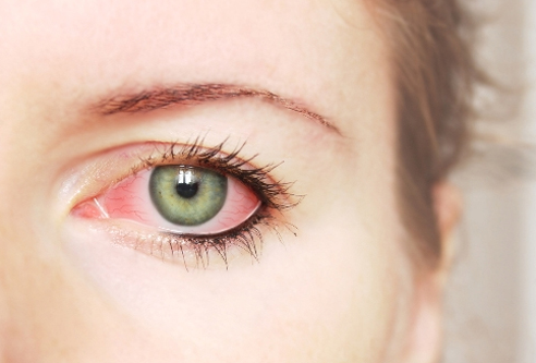 Đau mắt đỏ là bệnh gì điều trị như thế nào