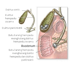 Tanda penyakit batu karang