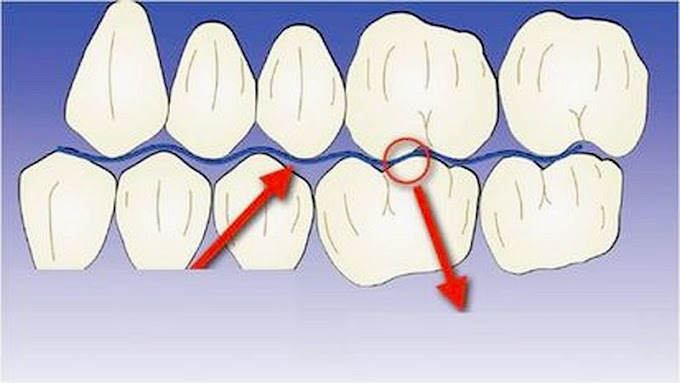 AJUSTE OCLUSAL: Indicaciones y técnicas