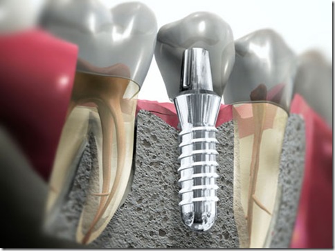 fotos implantes dentarios