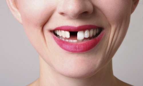 Tật nghiến răng có thể làm mất răng ở một số người