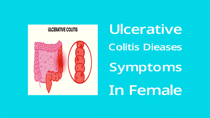 Ulcerative colitis disease symptoms (in females)