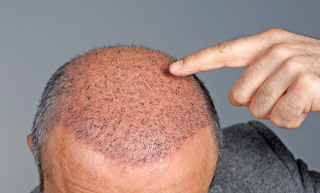 Hair Transplant in Ahmedabad