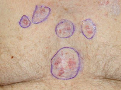 Age Spot Or Skin Cancer Pictures Photos