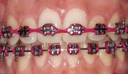 تعرف على الوان تقويم الاسنان وكيفية التركيب والاختيار