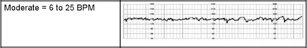 Moderate Fetal Heart Rate Monitoring Strip