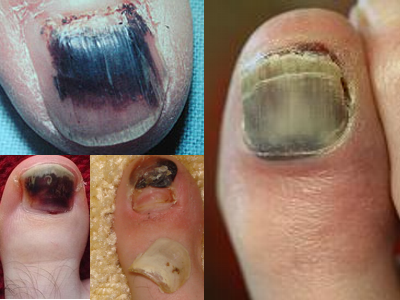 doookin: nail cancer pictures