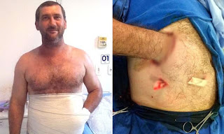 To Save This Man’s Hand, They Sewed It Into His Belly 