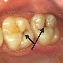 ¿Qué es una caries dental?