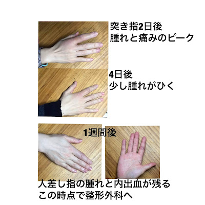 指の側副靭帯損傷