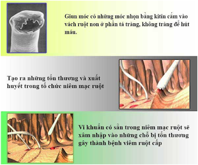 Giun móc gây viêm ruột