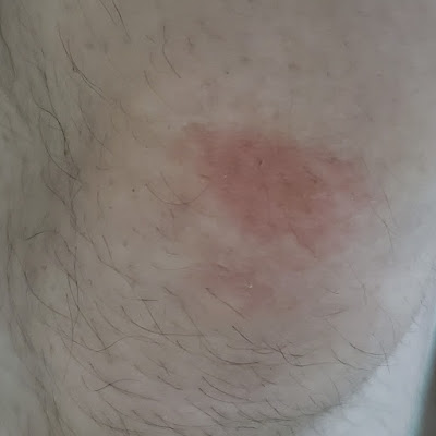 A pale person's knee. A silver dollar sized patch of skin on the knee cap is reddened. Dark hair grows through the skin.