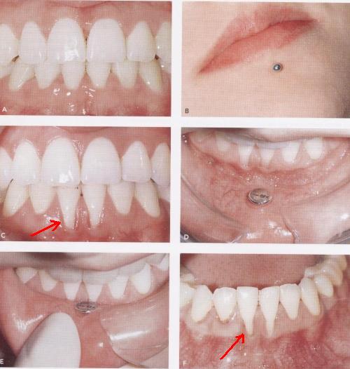 PIERCING EM TECIDOS MOLES DA BOCA: SEIS MOTIVOS PARA NÃO COLOCAR!