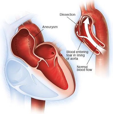 http://heartsurgeonindia.com/aortic-aneurysm-surgeries/aortic-dissection-repair/