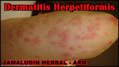 http://tilupuluhherbal.blogspot.co.id/2018/04/pengobatan-tradisional-dermatitis.html