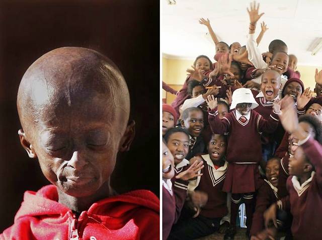 Ontlametse Falaste, Sang Gadis Cilik Berusia 12 Tahun Yang Terkena Penyakit Aneh Yang Membuat Tubuh Nya Kerdil [ www.BlogApaAja.com ]