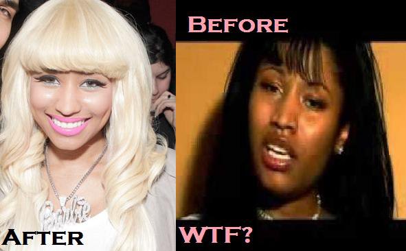 Nicki Minaj Before and After Surgery